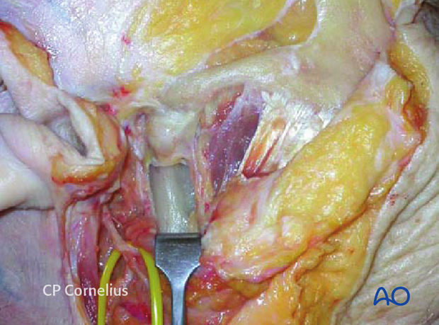 Exposure of the temporomandibular joint and/or mandibular condyle/ramus