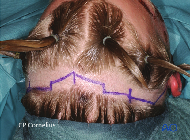 Complete drawing of the extended coronal scalp incision in a stepwise design
