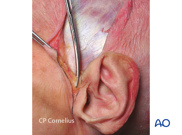 Transected preauricular muscles 