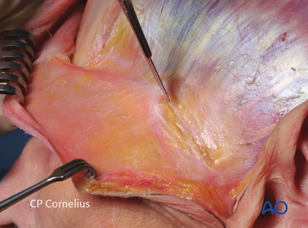 Incision of the superficial temporal fascia for exposure of the zygomatic arch 