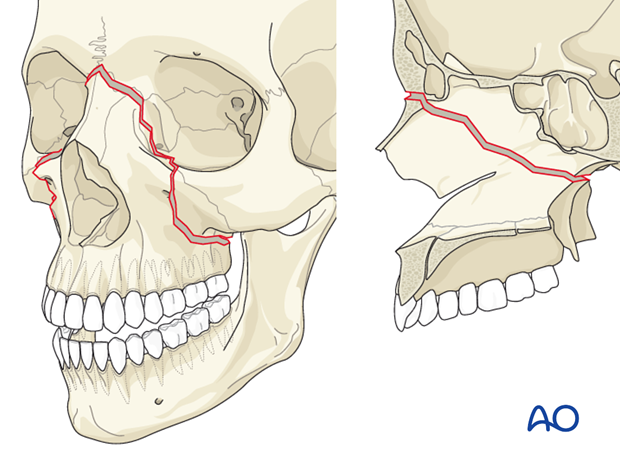 Le Fort II fracture