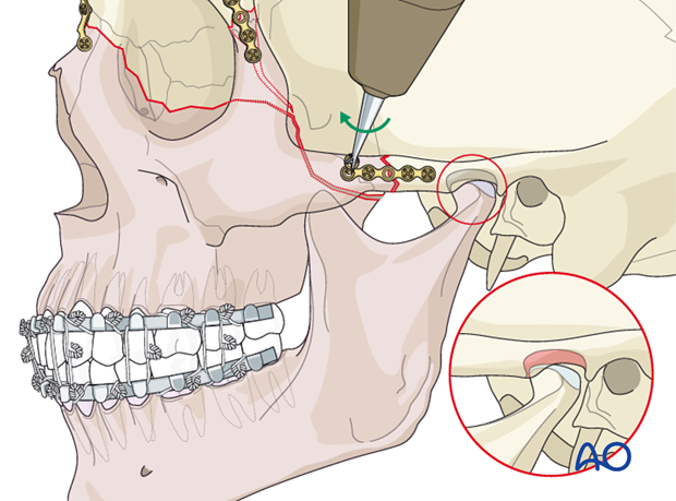 open reduction internal fixation