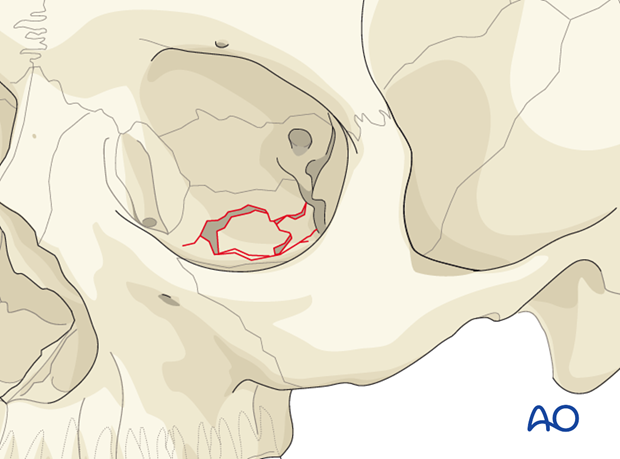 Orbital floor fracture