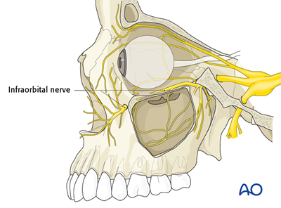 Orbital reconstruction for Orbit, orbital floor fracture