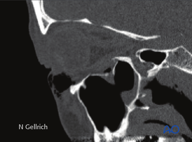 Orbital floor fracture