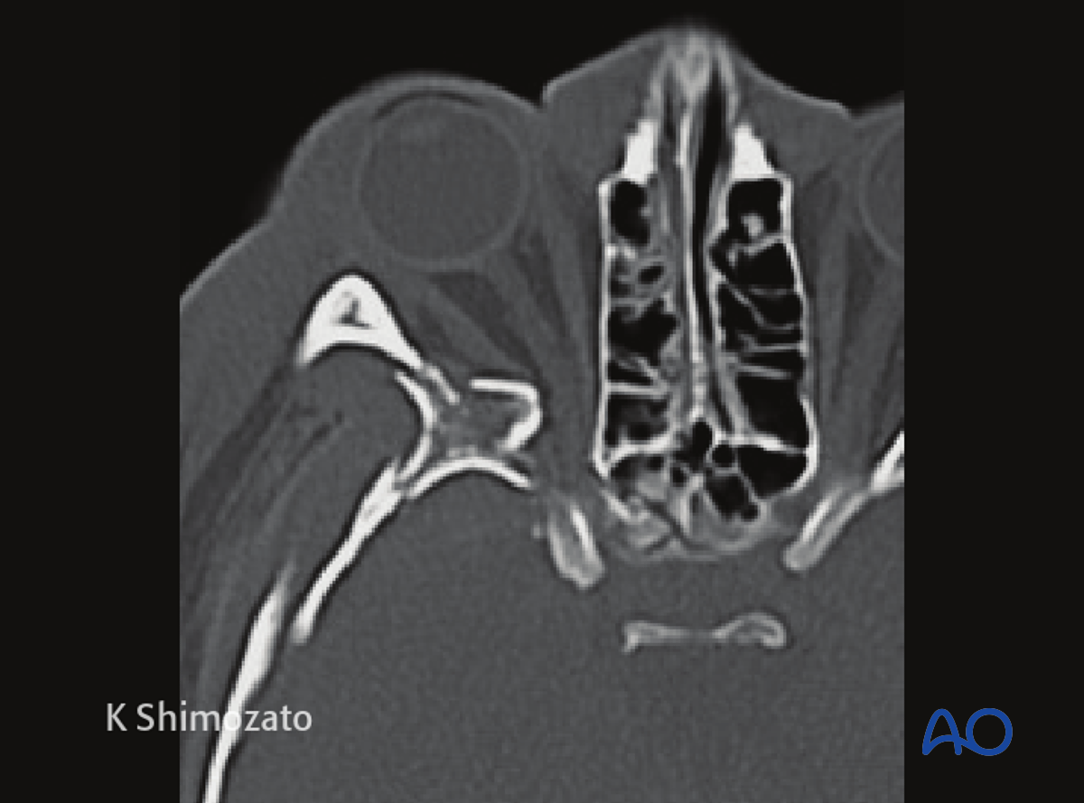 Orbital Reconstruction For Orbit, Orbital Floor Fracture