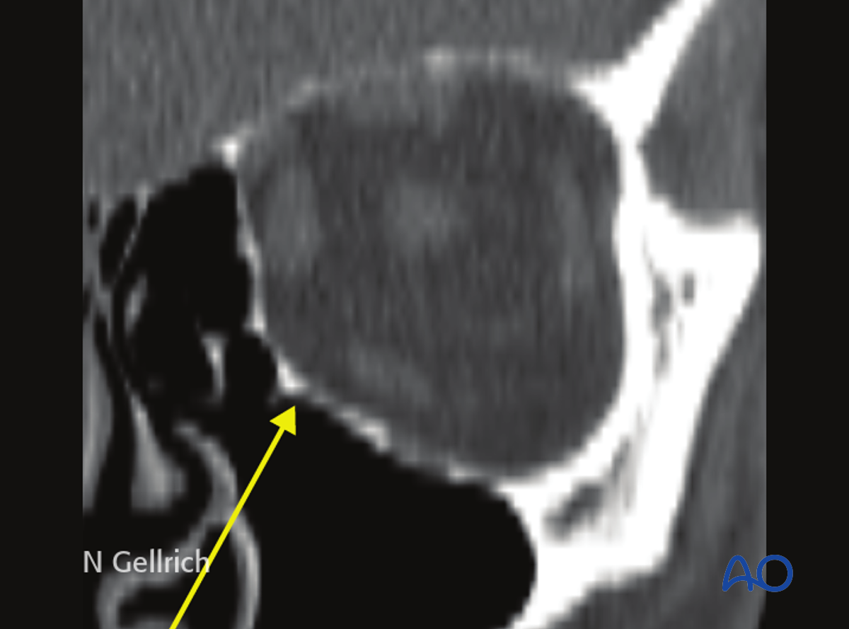 Orbital Reconstruction For Orbit, Orbital Floor Fracture