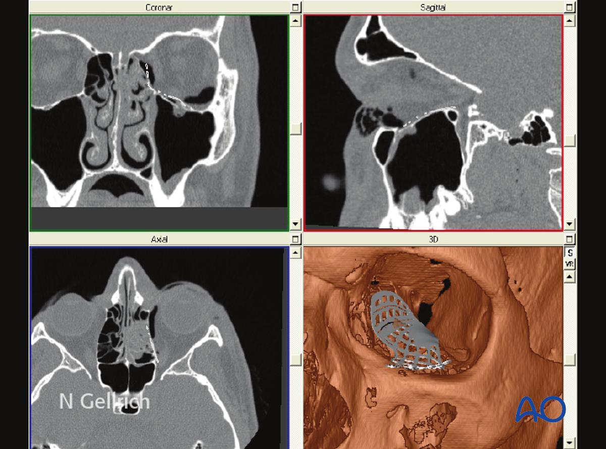 Orbital Reconstruction For Orbit, Orbital Floor Fracture