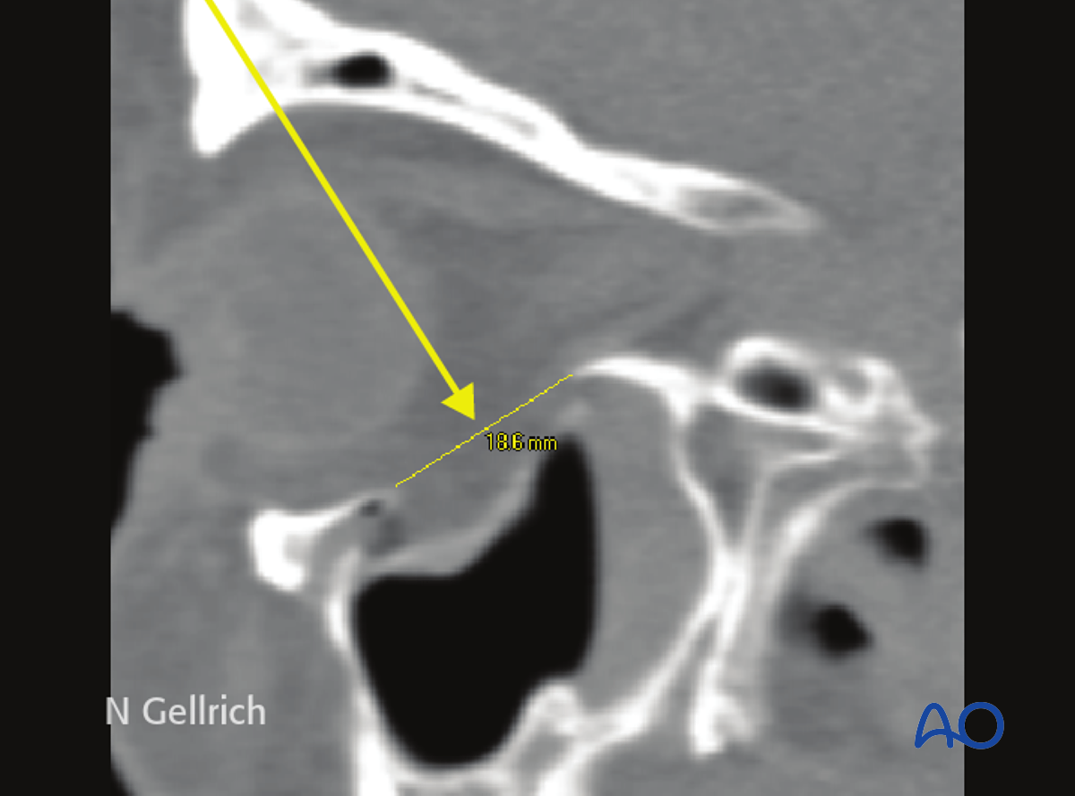 Orbital Reconstruction For Orbit, Orbital Floor Fracture