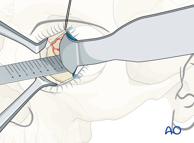 orbital reconstruction