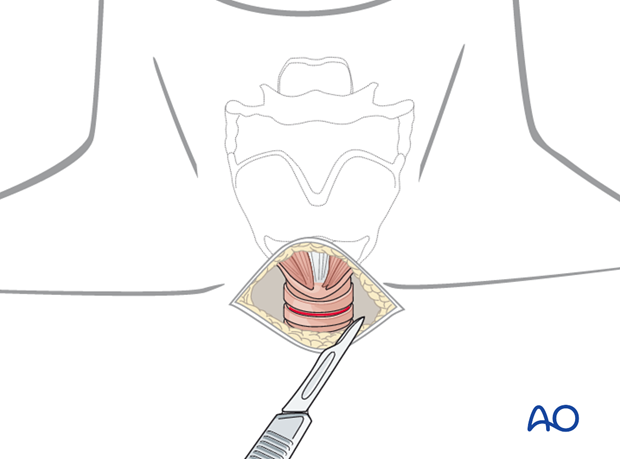 Airway considerations