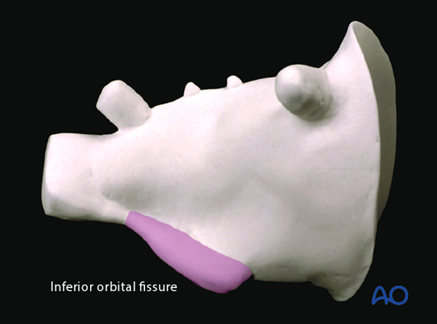 periorbital dissection of inferior orbital wall orbital floor