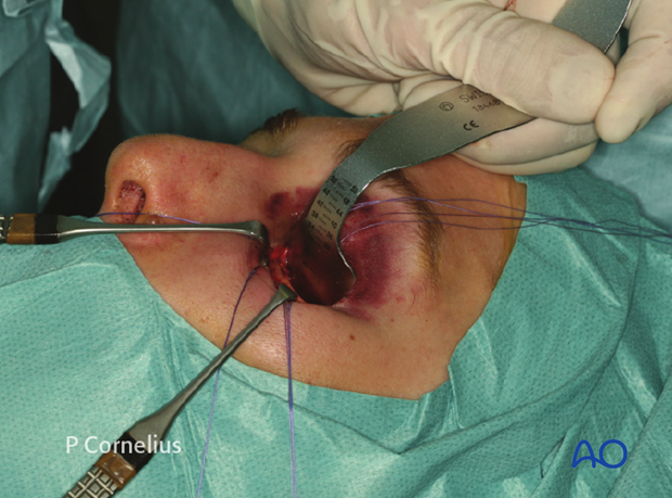 periorbital dissection of inferior orbital wall orbital floor