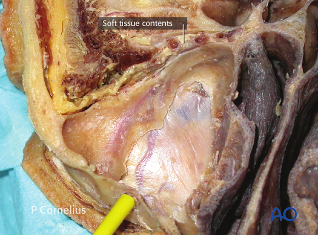 periorbital dissection of inferior orbital wall orbital floor