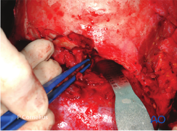 periorbital dissection of medial wall