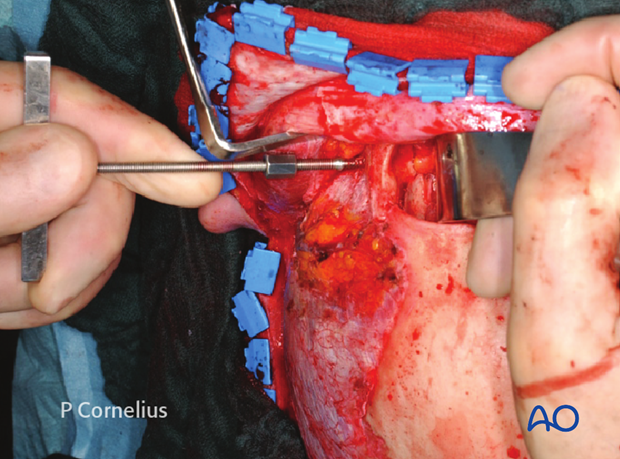 periorbital dissection of lateral orbital wall