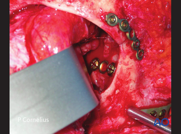 periorbital dissection of lateral orbital wall
