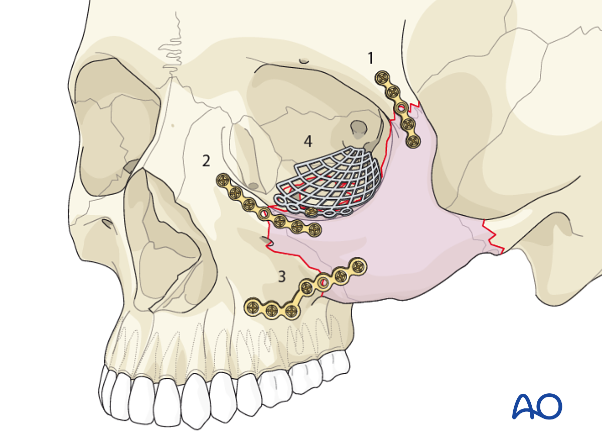 ORIF, 3-point Fixation (with Orbital Reconstruction) For Zygoma ...