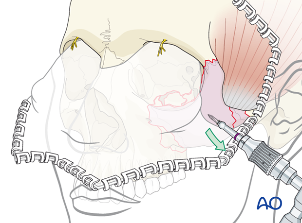 orif 4 point fixation with orbital reconstruction