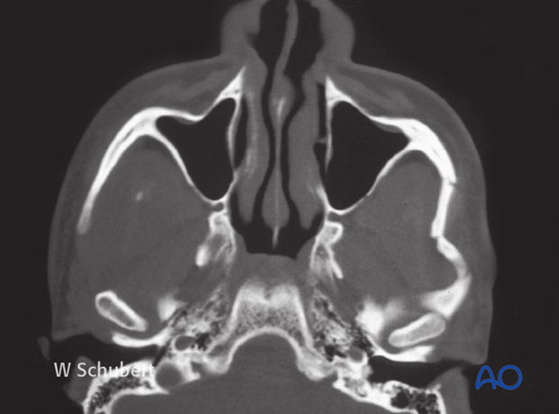 Zygomatic arch fracture