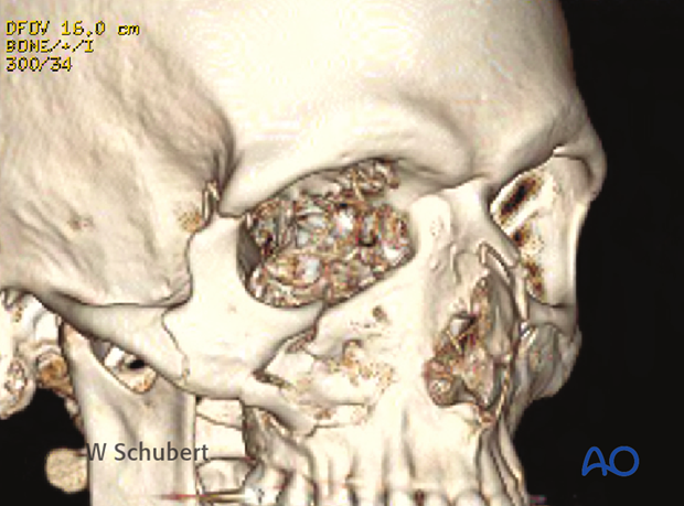 Zygomatic complex fracture