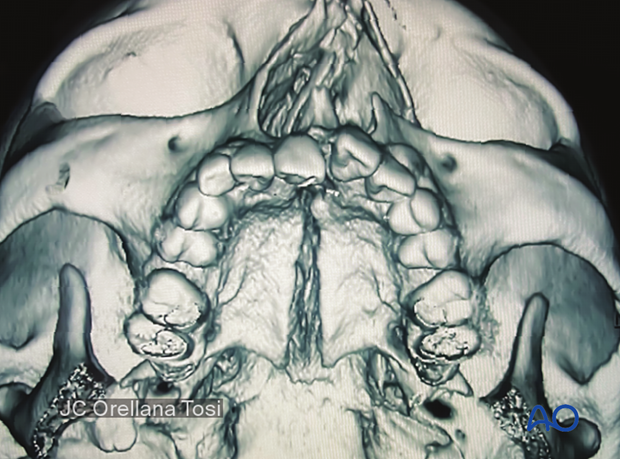 92_D100_i025 Simple palatoalveolar fracture - 3D reconstruction shows the palatal fracture pattern and displacement separated parallel to the midline suture