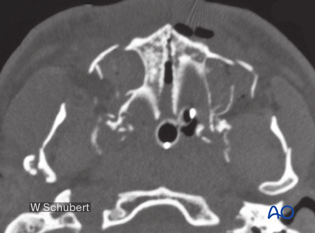 92_D100_i030 Simple palatoalveolar fracture - CT shows significant splaying of the palate in the midline. It also shows a Le Fort I fracture and significant mandibular fractures.