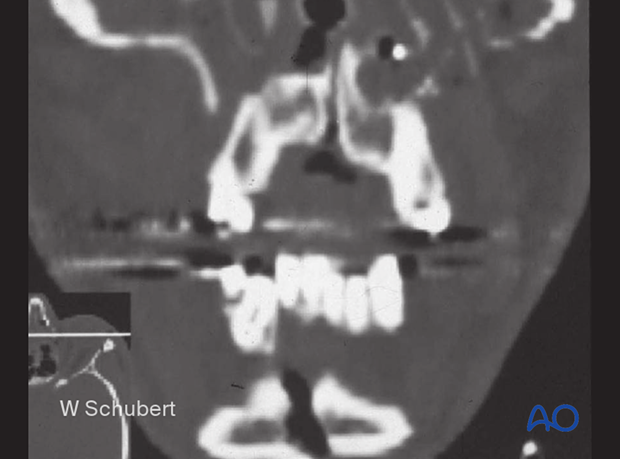 92_D100_i040 Simple palatoalveolar fracture - CT shows splaying of the palate in the midline and a mandibular symphyseal fracture with similar splaying.