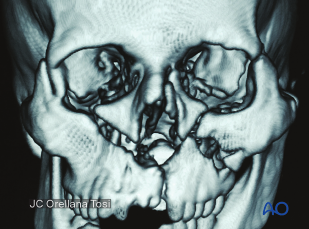 92_D100_i060 Simple palatoalveolar fracture - a right sided Le Fort III (zygomatic fracture) associated with Le Fort II and I fractures and an NOE fracture on the left side.