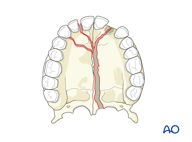 Comminuted palatoalveolar fracture