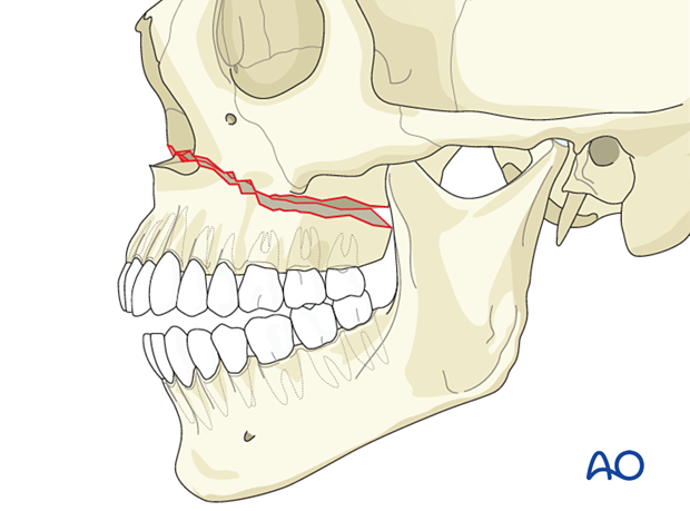 Le Fort I linear fracture