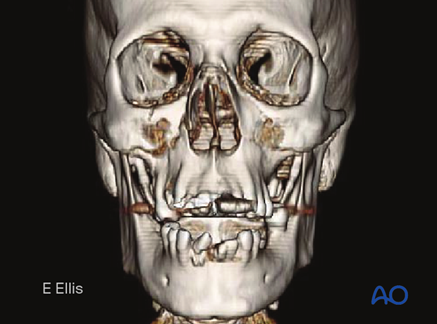 Le Fort I fracture – frontal view