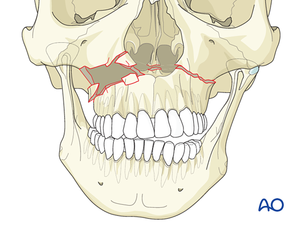Le Fort I fracture
