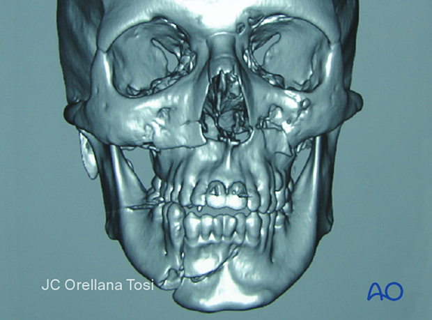 92 D210 Definition