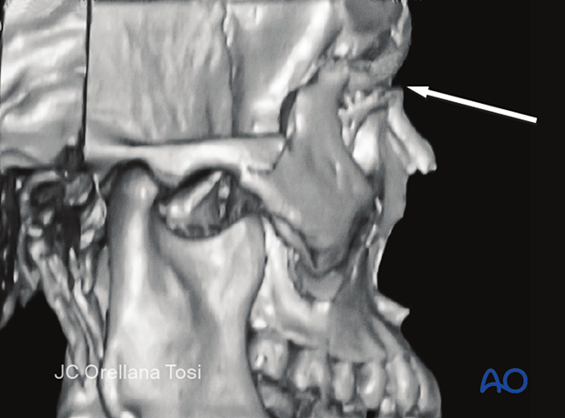 Le Fort III fracture