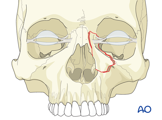 Diagnosis of NOE fractures