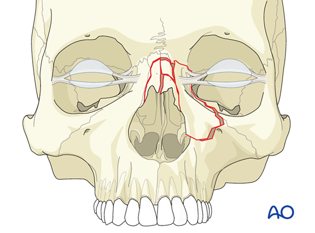 Diagnosis of NOE fractures