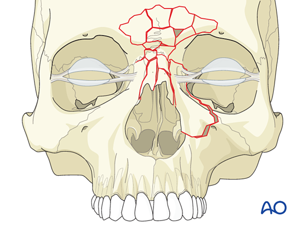 Diagnosis of NOE fractures