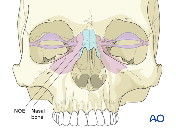 Diagnosis of NOE fractures
