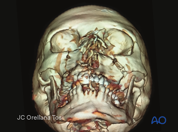 Diagnosis of NOE fractures