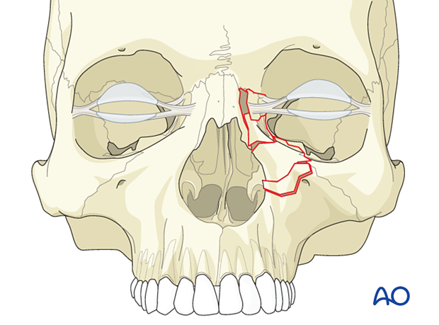 Diagnosis of NOE fractures