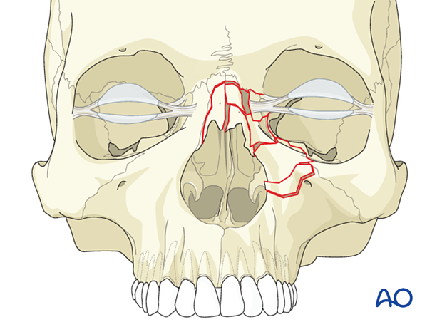 Diagnosis of NOE fractures