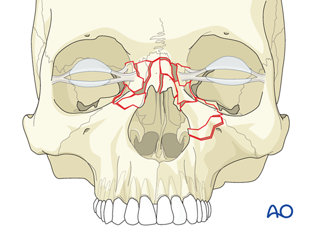 Diagnosis of NOE fractures