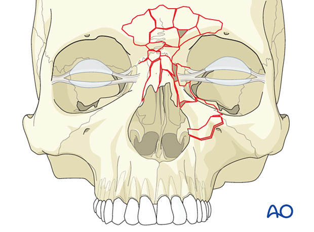 Diagnosis of NOE fractures