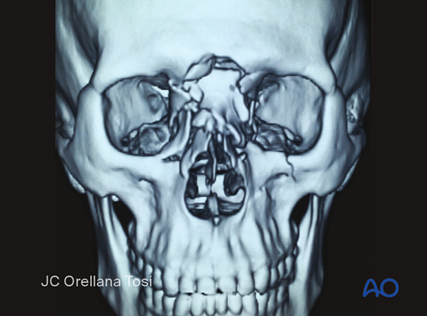 Diagnosis of NOE fractures