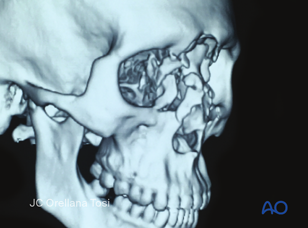 Diagnosis of NOE fractures