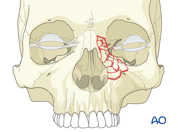 Diagnosis of NOE fractures