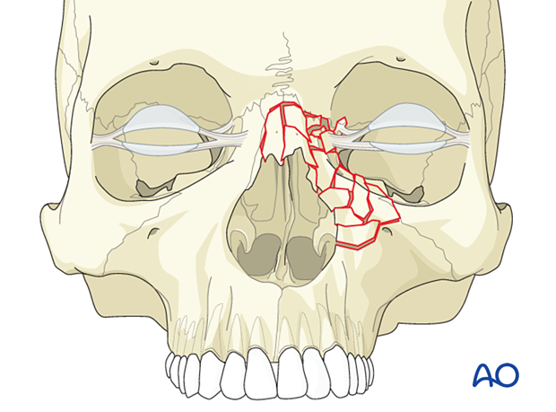 Diagnosis of NOE fractures