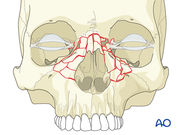 Diagnosis of NOE fractures