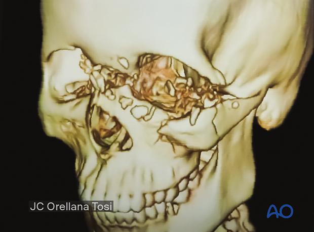 Diagnosis of NOE fractures